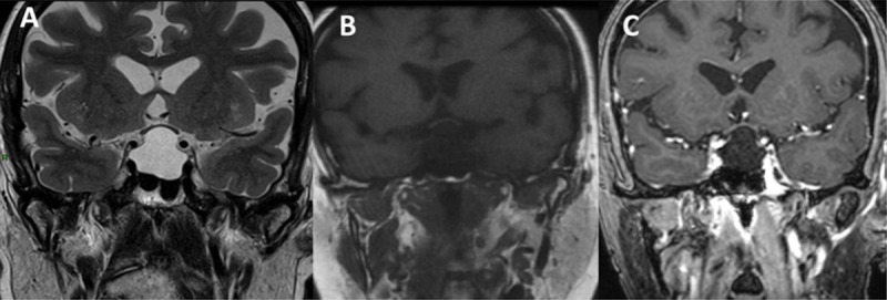 Figure 1 Intrasellar and suprasellar lesion in a 67-year-old female patient, which is hyperintense in on coronal T2WI (A), hypointense on coronal T1WI (B), and no enhancement is observed on contrast-enhanced T1WI (C) diagnosed as Rathke’s cleft cyst pathologically.