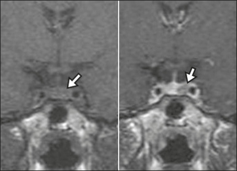 Dynamic contrast-enhanced coronal T1-weighted MRI sequences showing a microadenoma in the left portion of the adenohypophysis (arrows). Note that contrast enhancement was slower in the microadenoma than in the normal pituitary parenchyma.